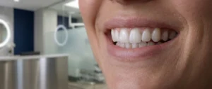Diş Beyazlatma (Bleaching) ile Özgüvenli Bir Gülümseme: Bilmeniz Gereken Her Şey